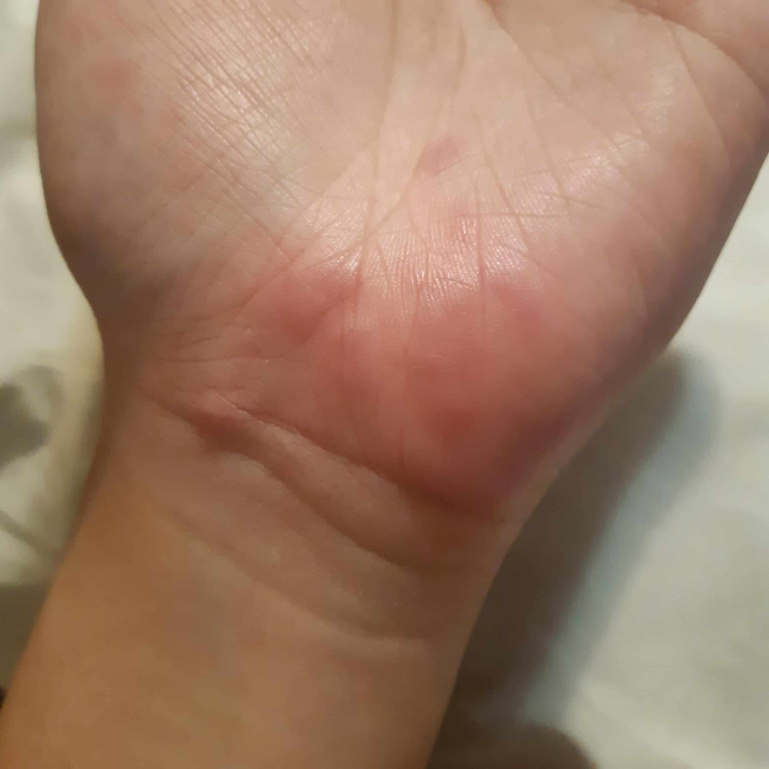 First time here. Does this look like dyshidrotic eczema? : Dyshidrosis