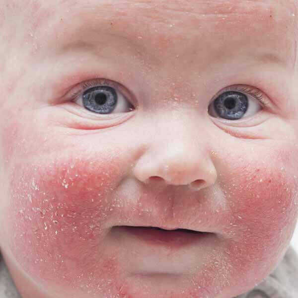 Food Allergies Begin with Eczema