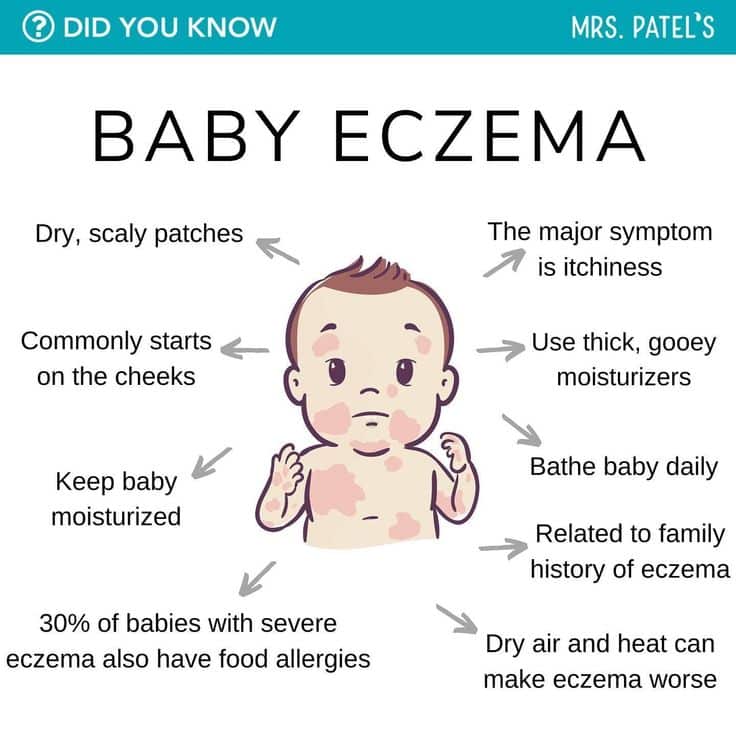 food that trigger eczema in baby