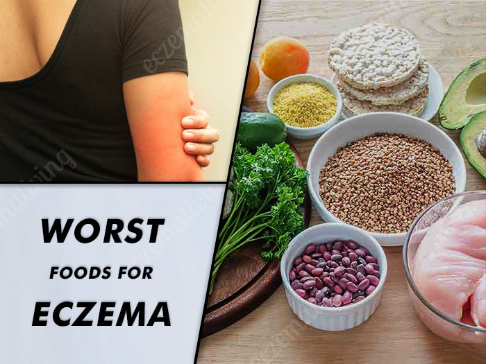 Food Triggers Eczema  Foods to Avoid To Get Rid Of Eczema ...