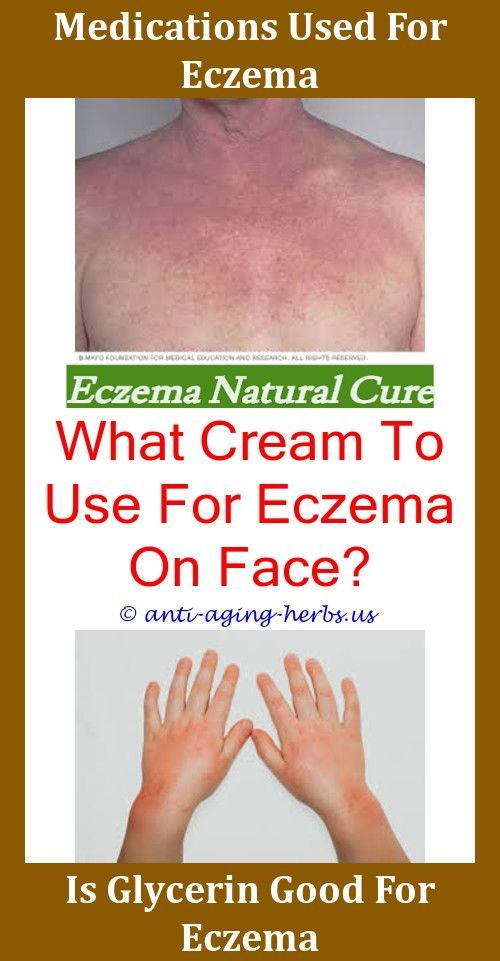 Foot Eczema Treatment How To Get Rid Of Eczema Fast On Face What Can U ...
