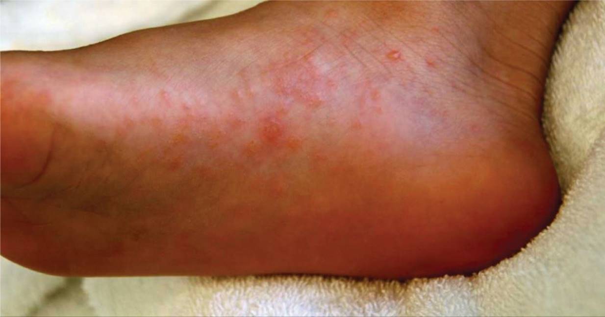 Foot Rashes and Lumps
