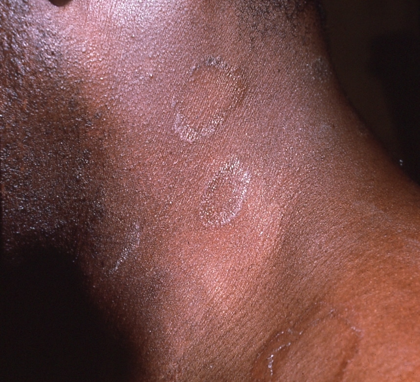 [Get 43+] Eczema Mild Psoriasis On Black Skin