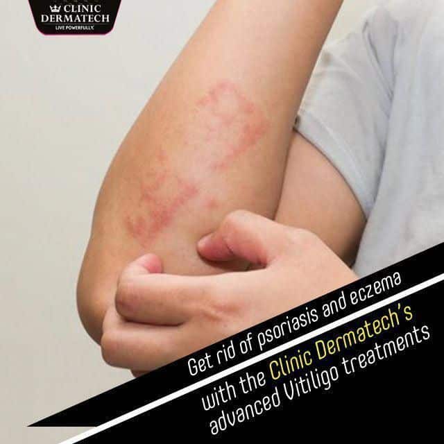Get rid of psoriasis and eczema with the #clinic #dermatechs advanced # ...