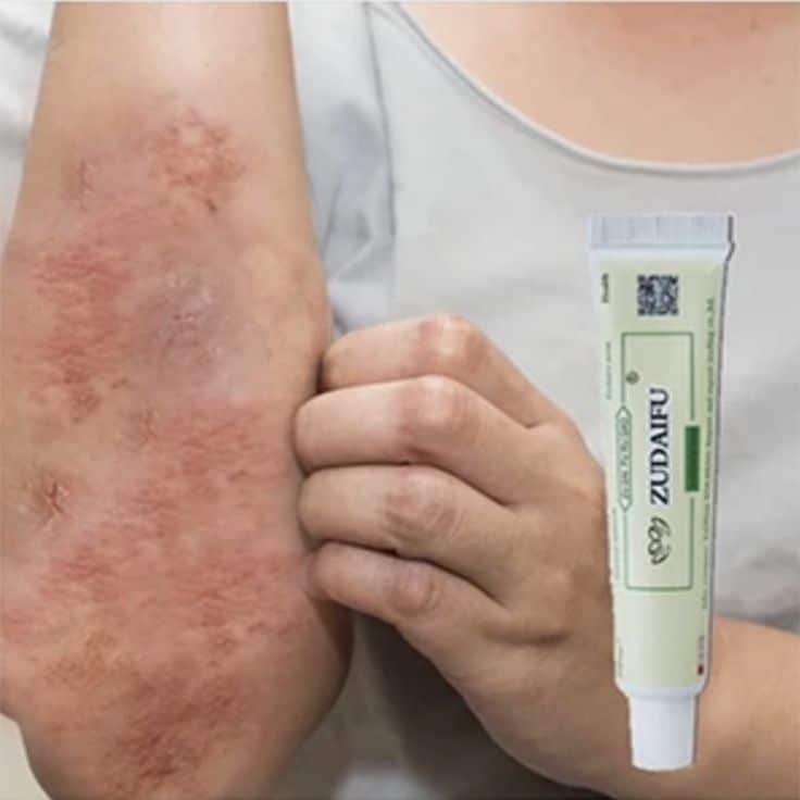 " Get the Pure Natural Remedy for Eczema and say Goodbye to Damaged Skin ...