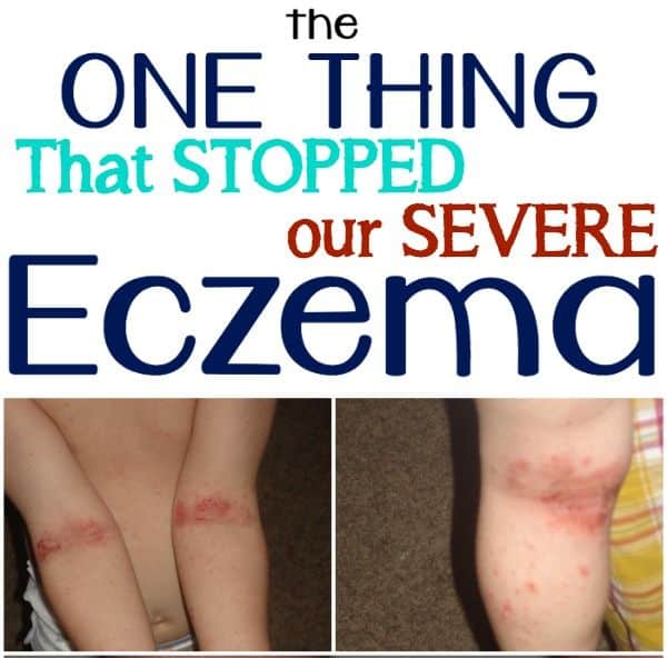 Goodbye Eczema!