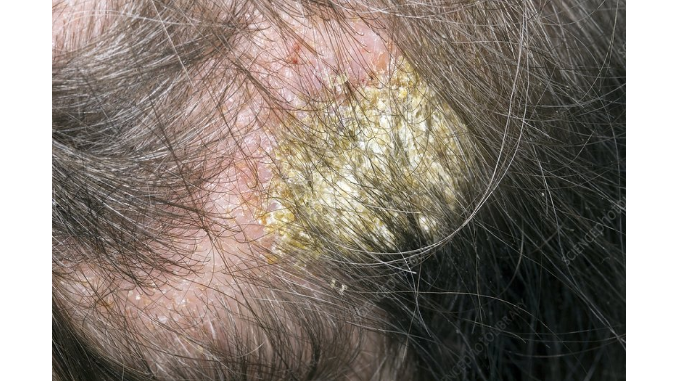Got Eczema On Your Scalp? We Know A Secret!
