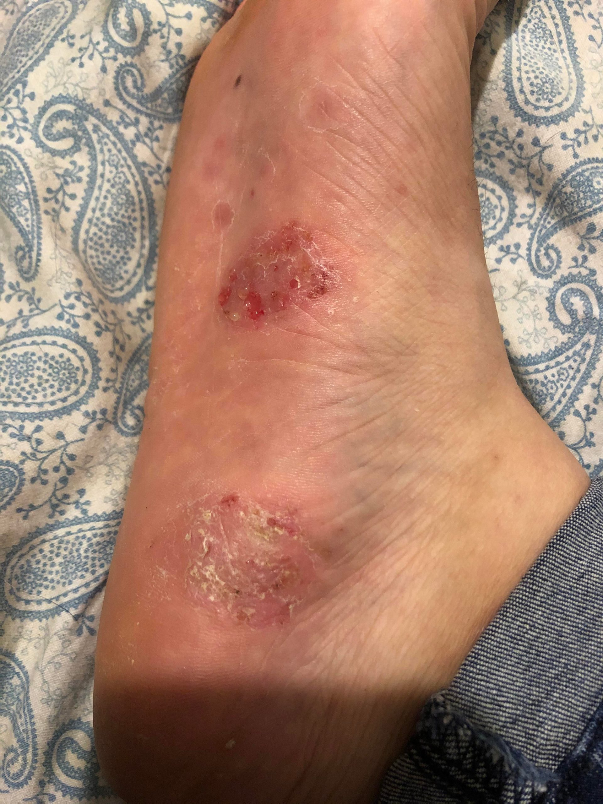 Gotta love the dishydrotic eczema on my foot. Only ever been on the ...