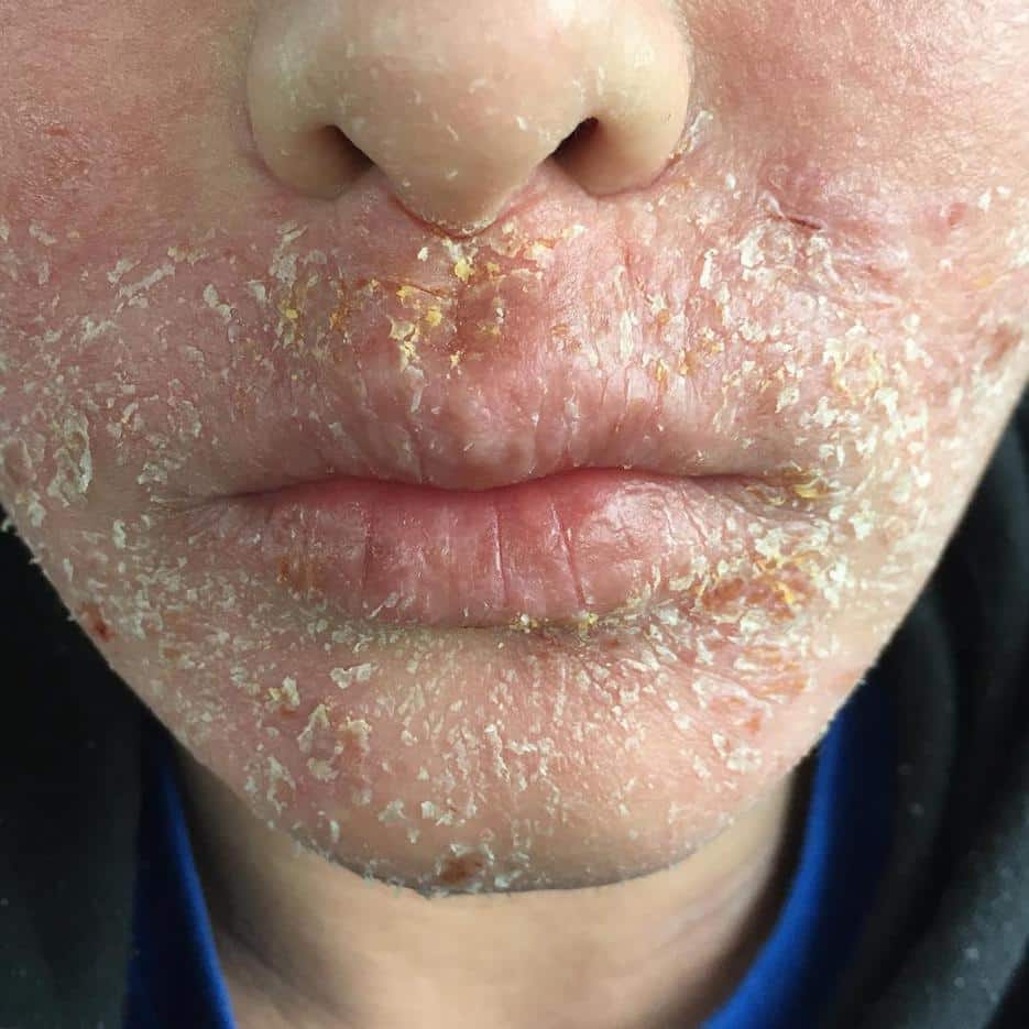 Graphic pictures show the horror of eczema sufferers