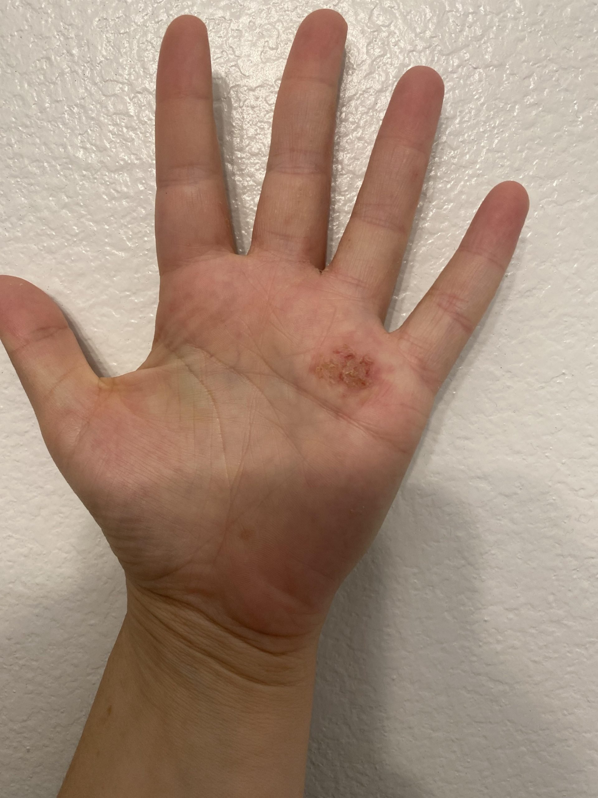 Grateful I found this sub. i was in eczema but this seems ...