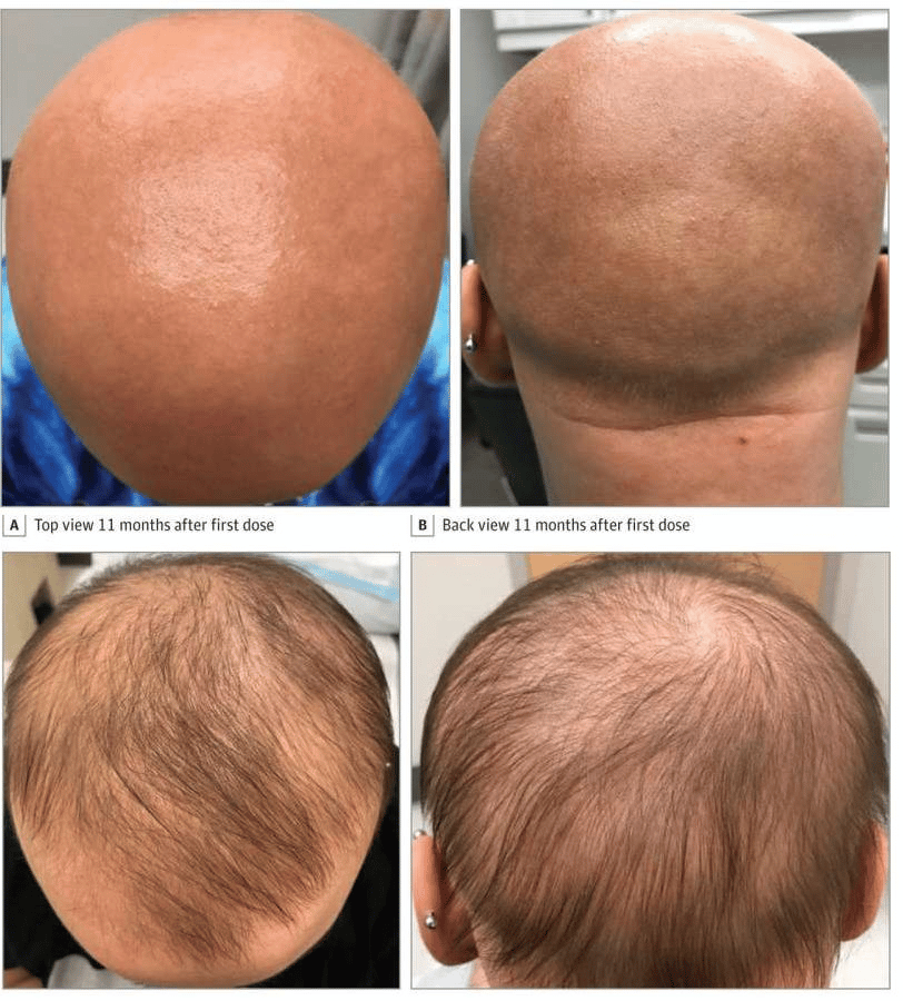 Hair Loss Due To Eczema / Can Dandruff Cause Hair Loss It Really Works ...