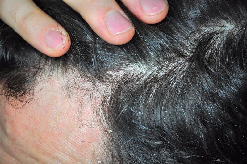 Hair Loss Eczema