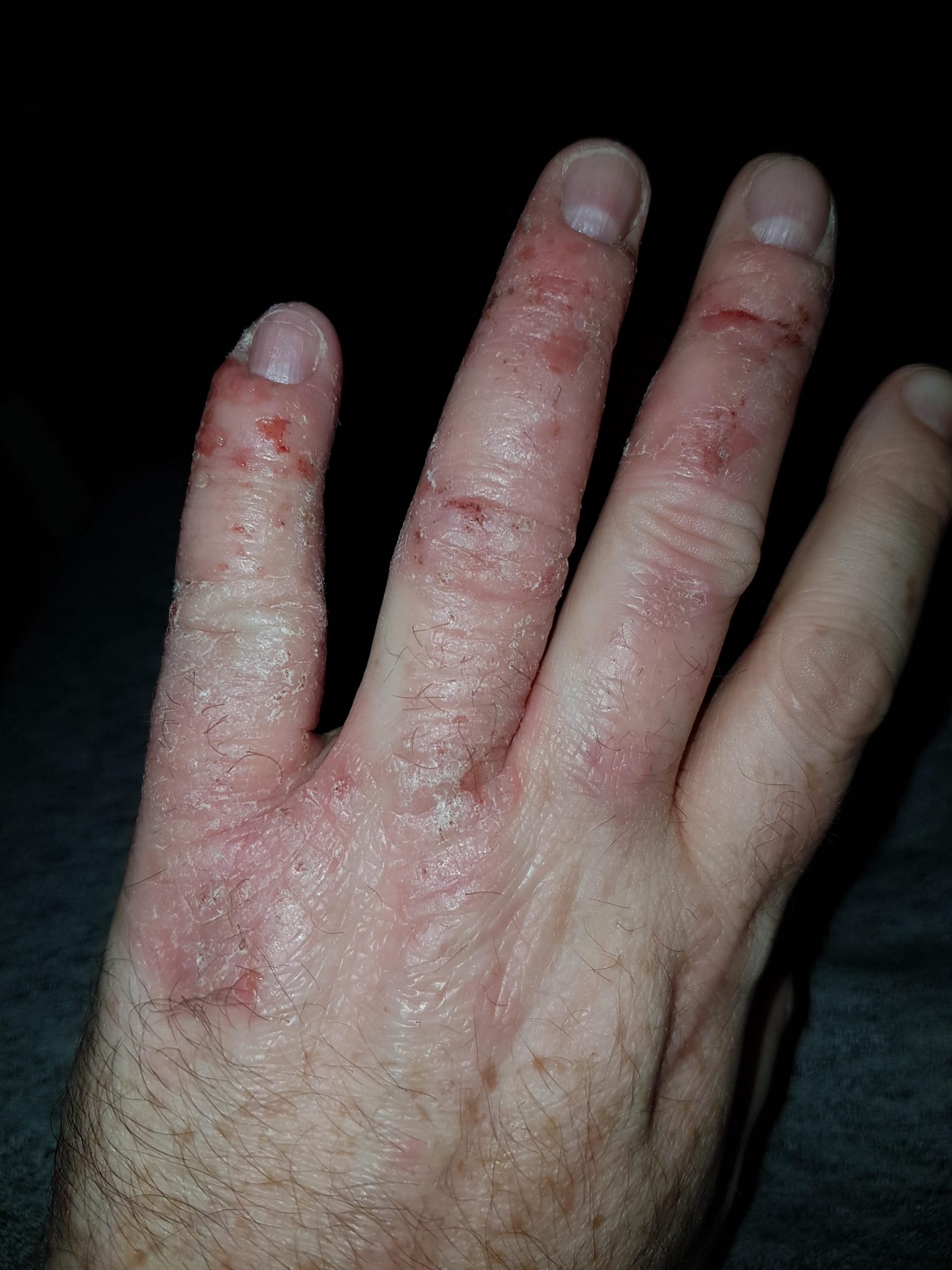 Hand atopic eczema : eczema