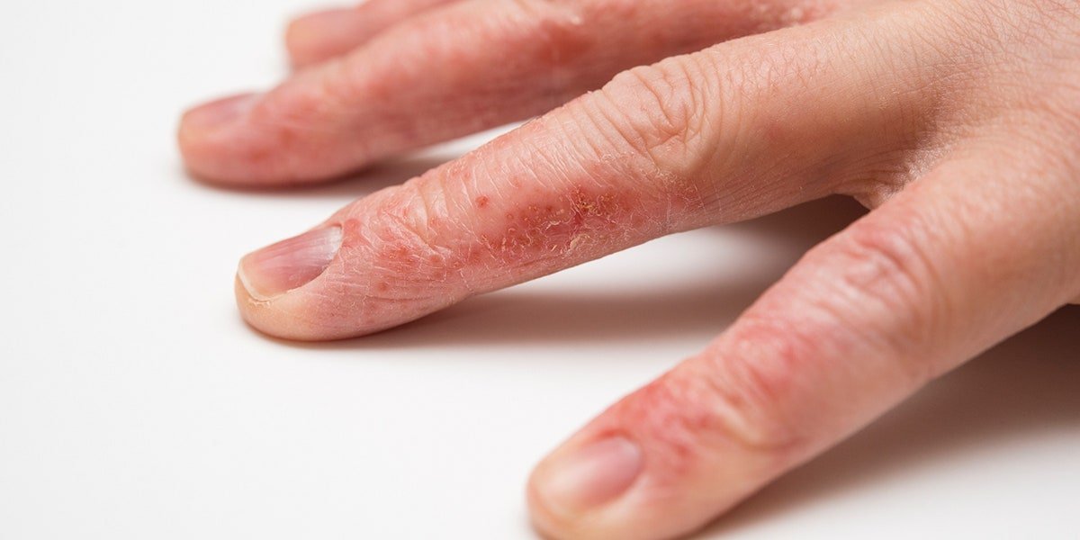 Hand Eczema: 8 Ways to Deal With This Frustrating Condition