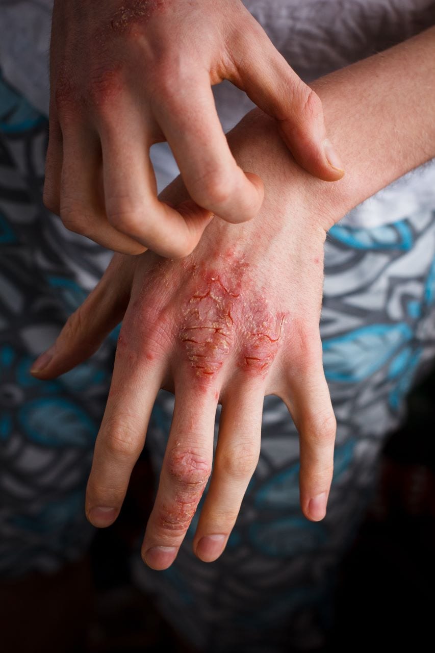 Hand Eczema