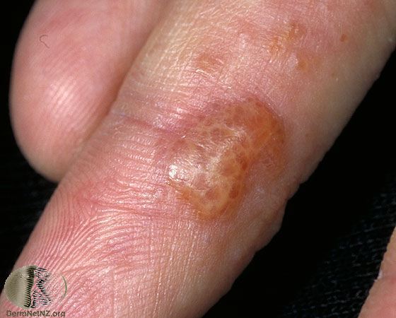 Hand Eczema Blisters