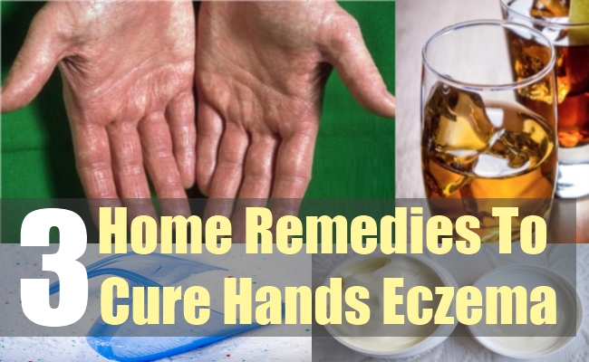 Hand Eczema Home Remedies