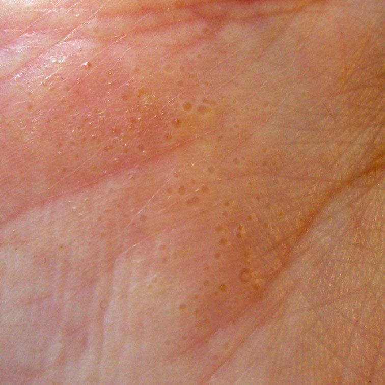 Hand Eczema or Dyshidrosis. This is a picture of my hand ...