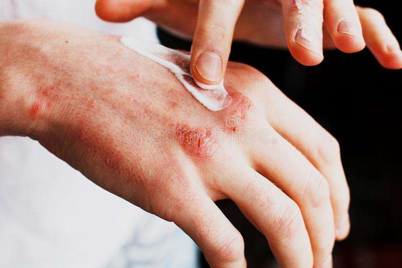 Hand Eczema &  stress related Its Symptoms, Treatment and ...
