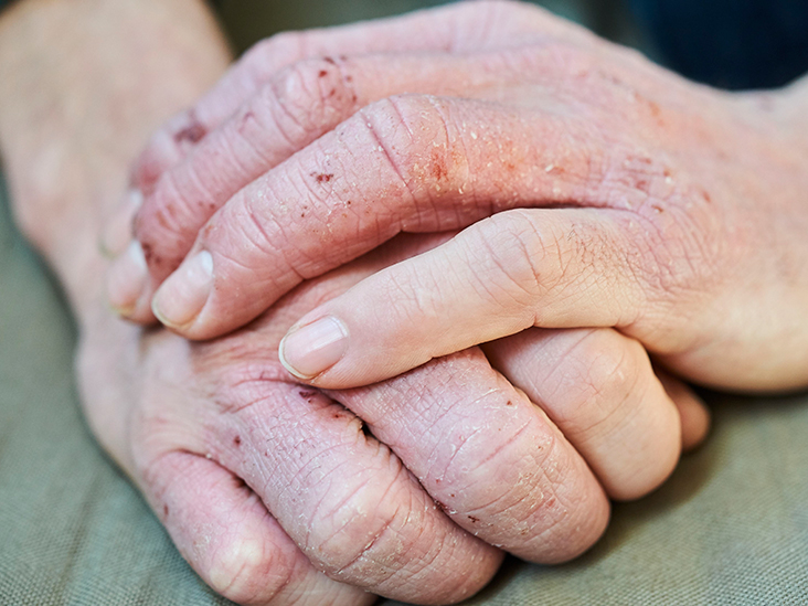 Hand eczema: Treatment, prevention, and more