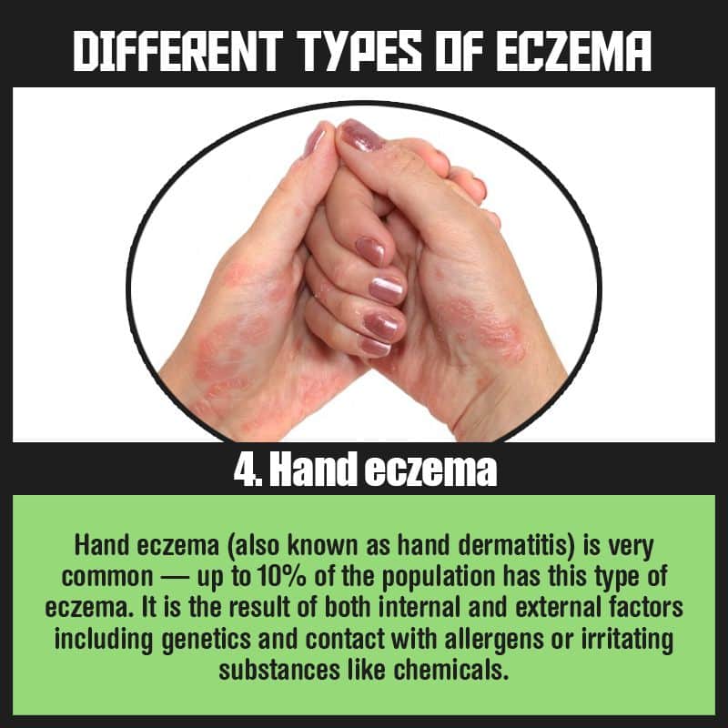 Hand eczema