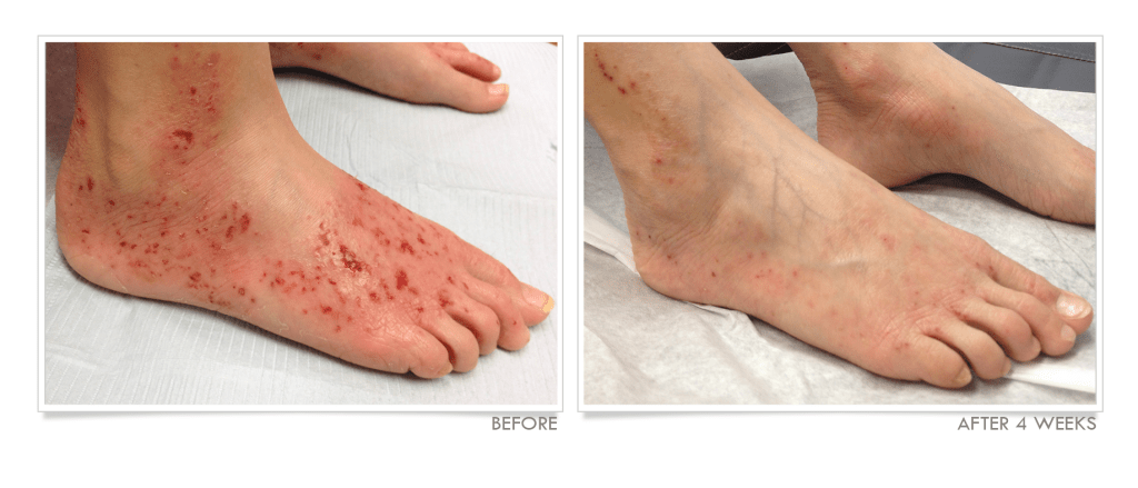 Hands &  Feet with Eczema