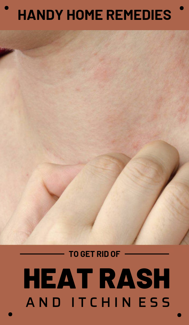 Handy Home Remedies To Get Rid Of Heat Rash And Itchiness