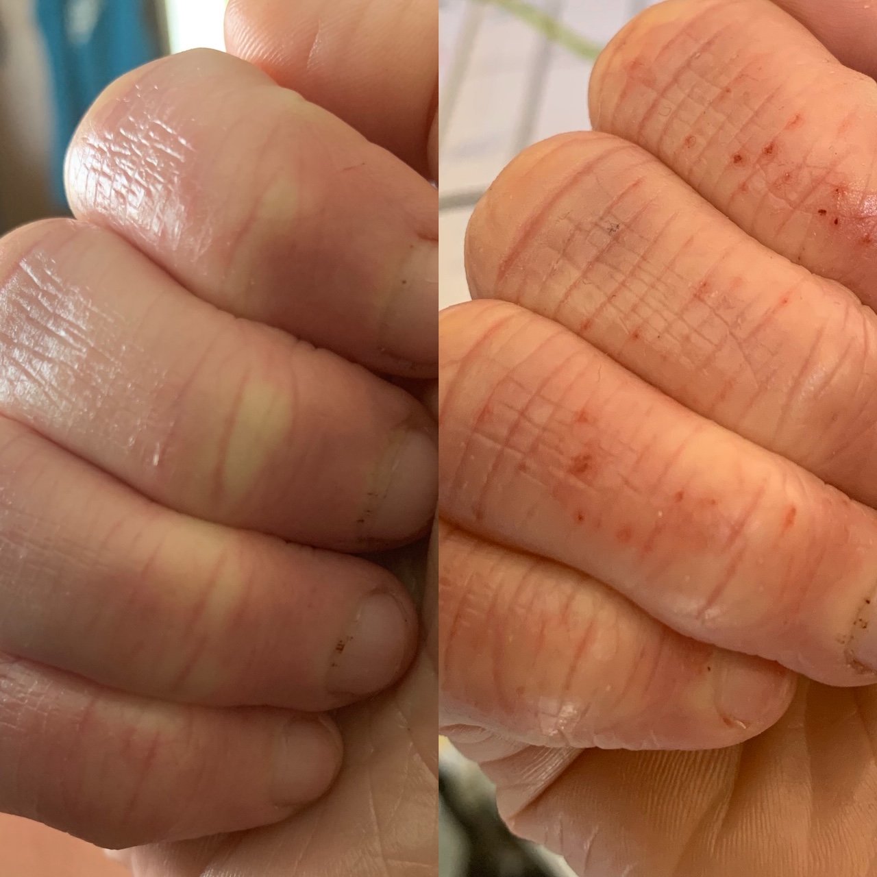 Healing bad hand eczema