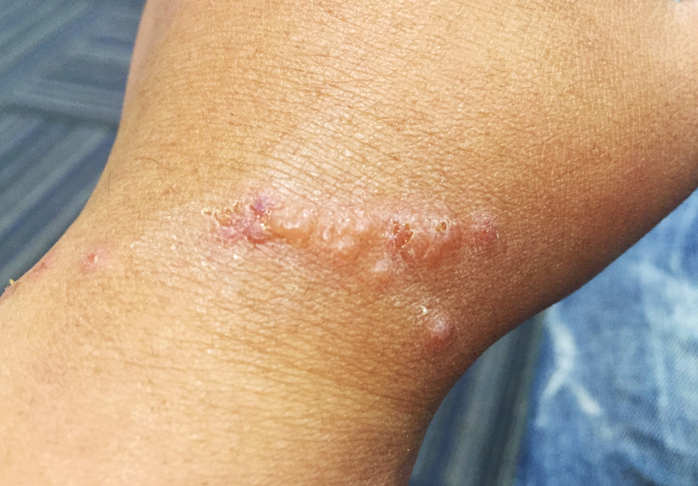 Help! I Have Itchy Blisters on My Skin: Dyshidrotic Eczema â Cottonique ...