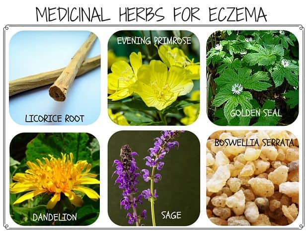 Herbs for Eczema