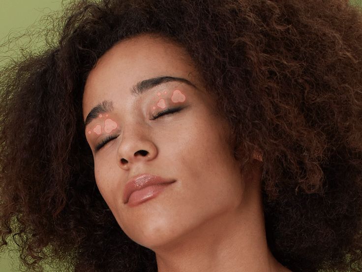 Heres Exactly What to Do About Eczema on Your Eyelid
