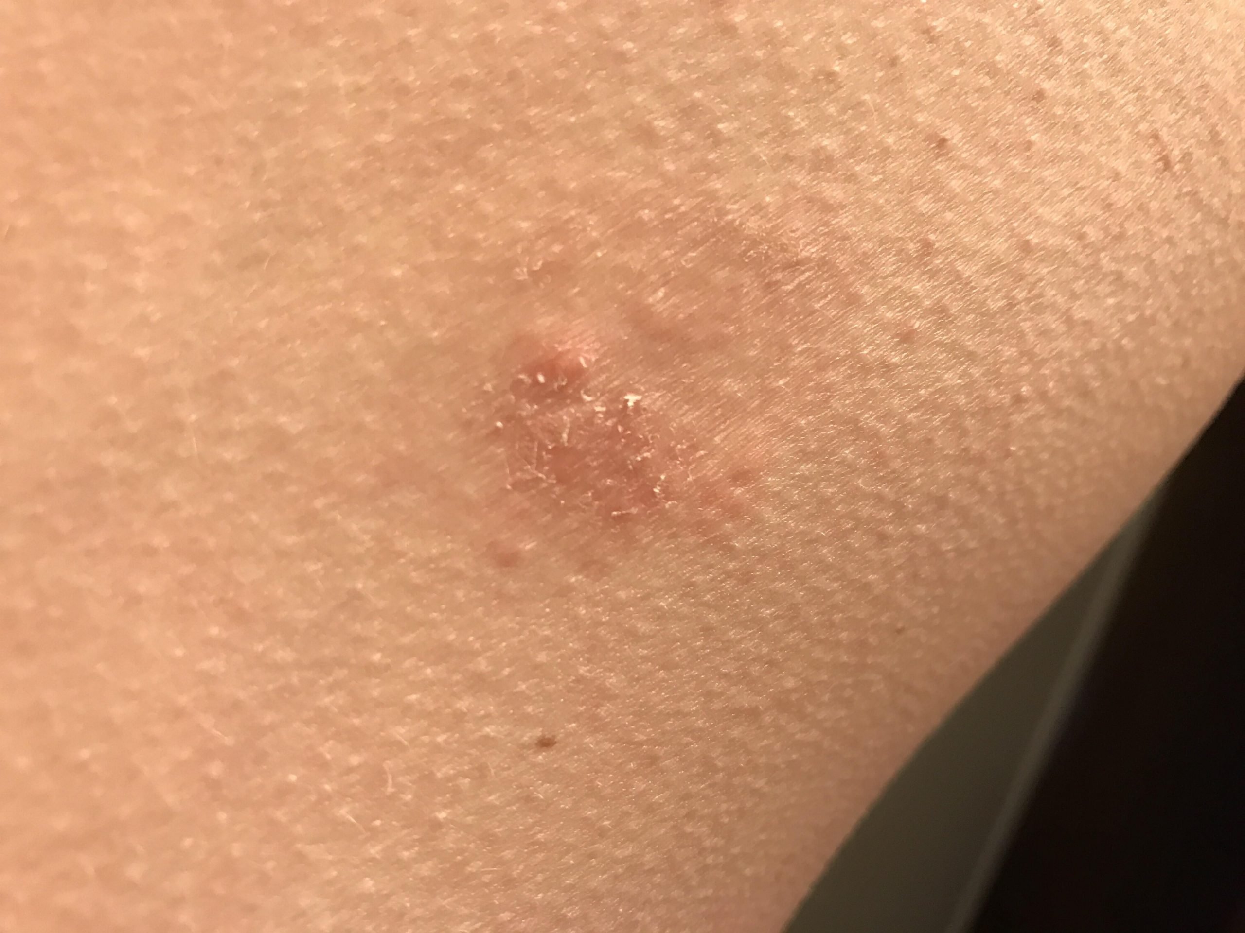 Hey guys! This dry and itchy patch of skin has been sticking around for ...