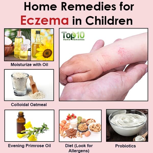 Home Cure For Eczema : 9 Home Remedies for Treating Eczema Â« The Secret ...