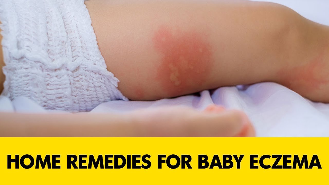 Home remedies for baby eczema on face
