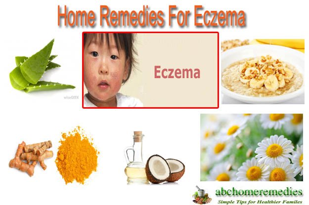 Home Remedies For Eczema