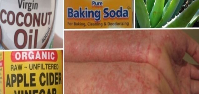 Home Remedies For Really Bad Eczema