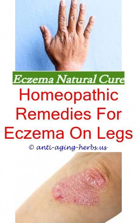 Home remedies for severe eczema.Hydrocerin cream for ...