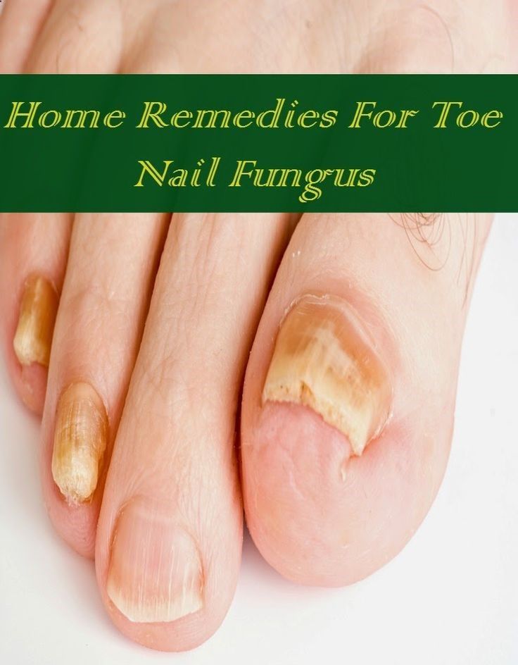 Home Remedies For Toe Nail Fungus