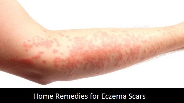 Home Remedies to Get Rid of Eczema Scars