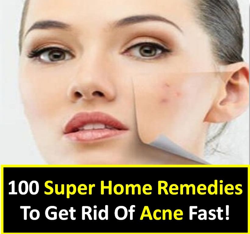 Home Remedies To Get Rid Of Lice: Home Remedies For Acne Fast Working