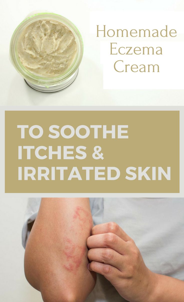 Homemade Eczema Cream To Soothe Itches &  Irritated Skin # ...