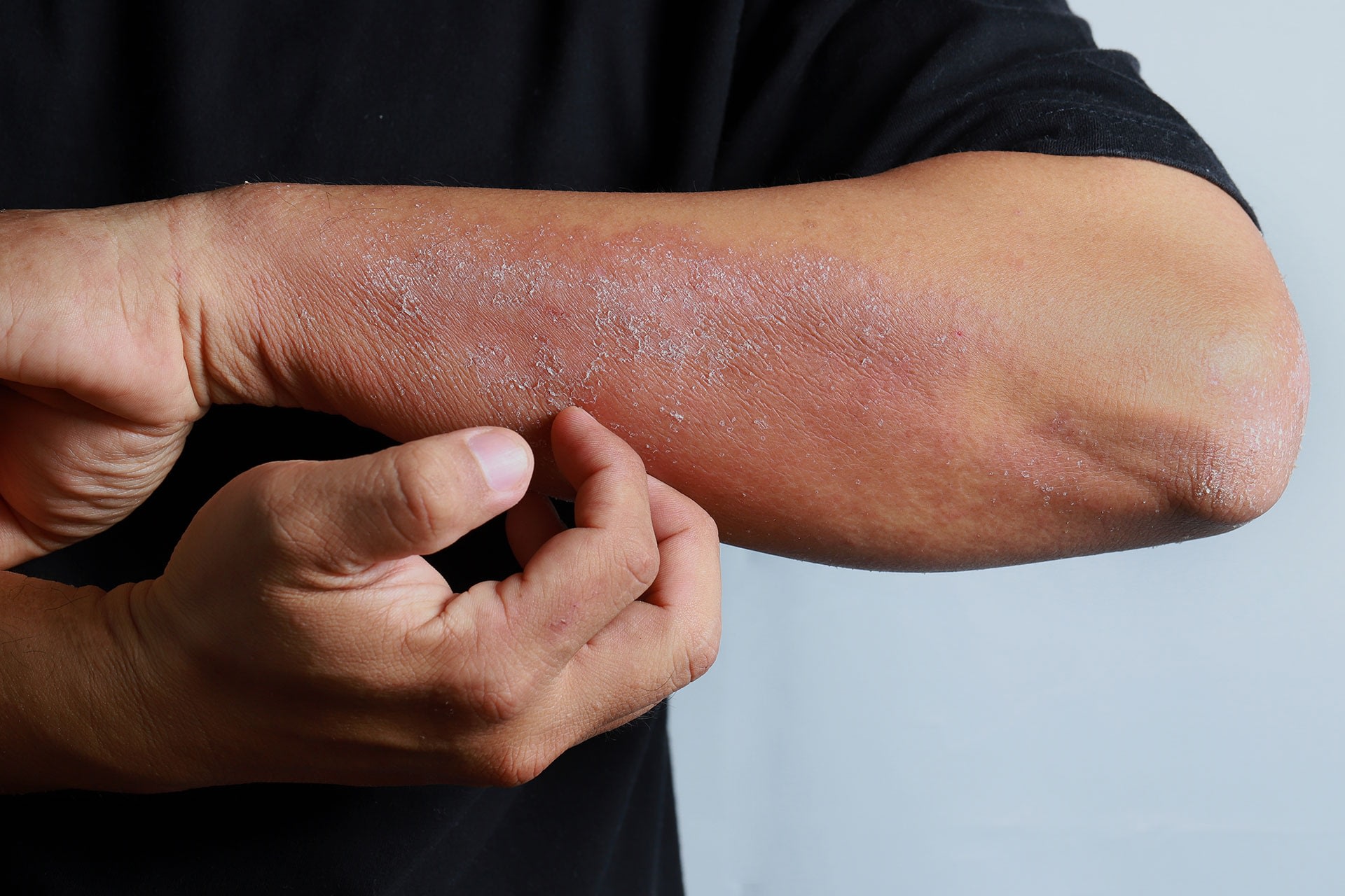 Homemade Eczema Remedy To Heal Your Skin