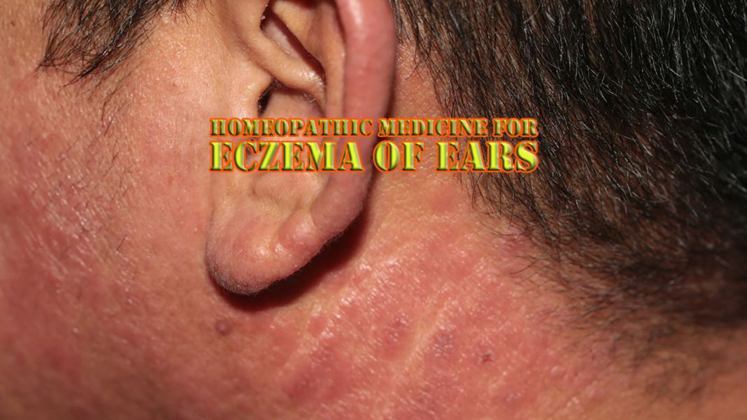 Homeopathic Medicine for Eczema of Ears â Homeopathic ...