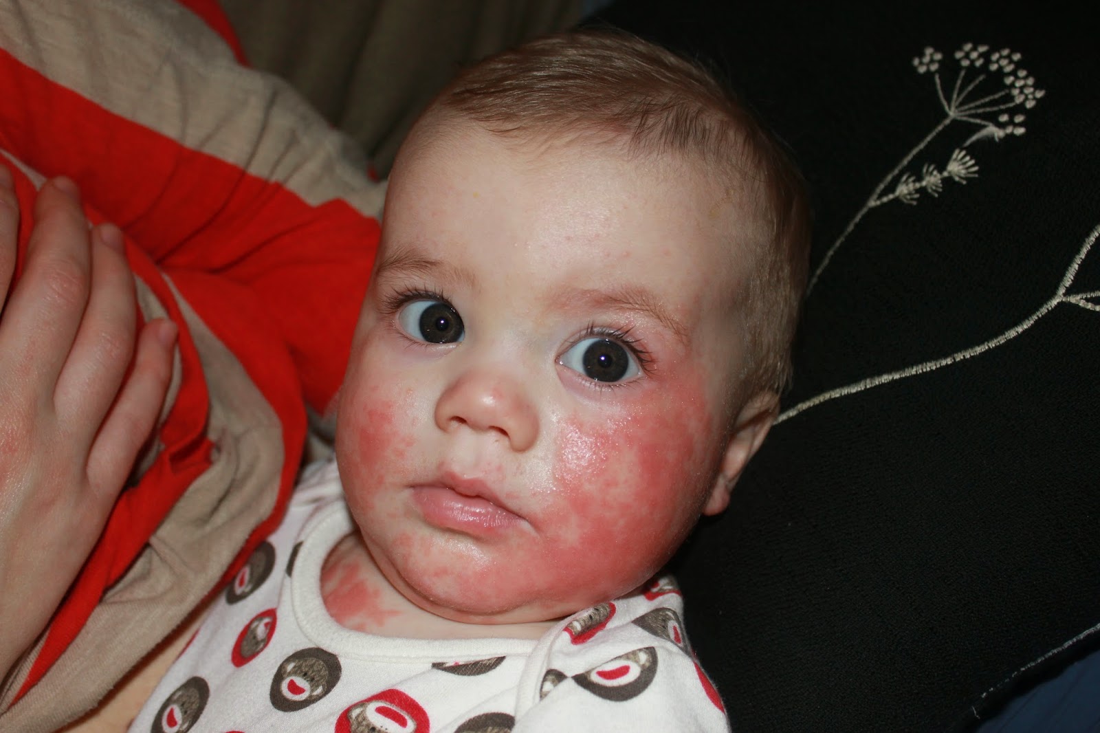 House of Thorns: Infant Eczema + Allergies and Why I