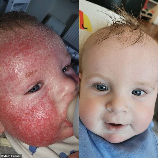 How a severe milk allergy left baby Arthur screaming in agony with ...