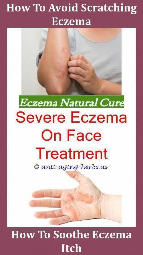 How Can I Treat Eczema Best Shower Oil For Eczema,bad case ...