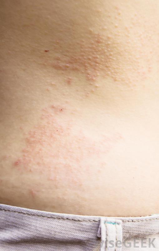How Do I Choose the Best Eczema Specialist? (with pictures)