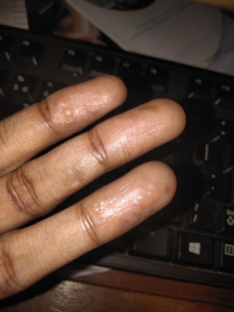 How do I get rid of dyshidrotic eczema on my hands?