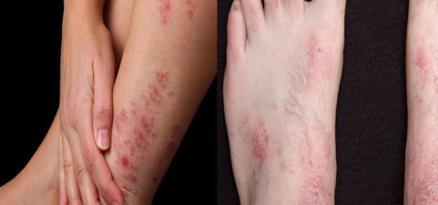 How Do You Know If You Have Psoriasis Or Eczema