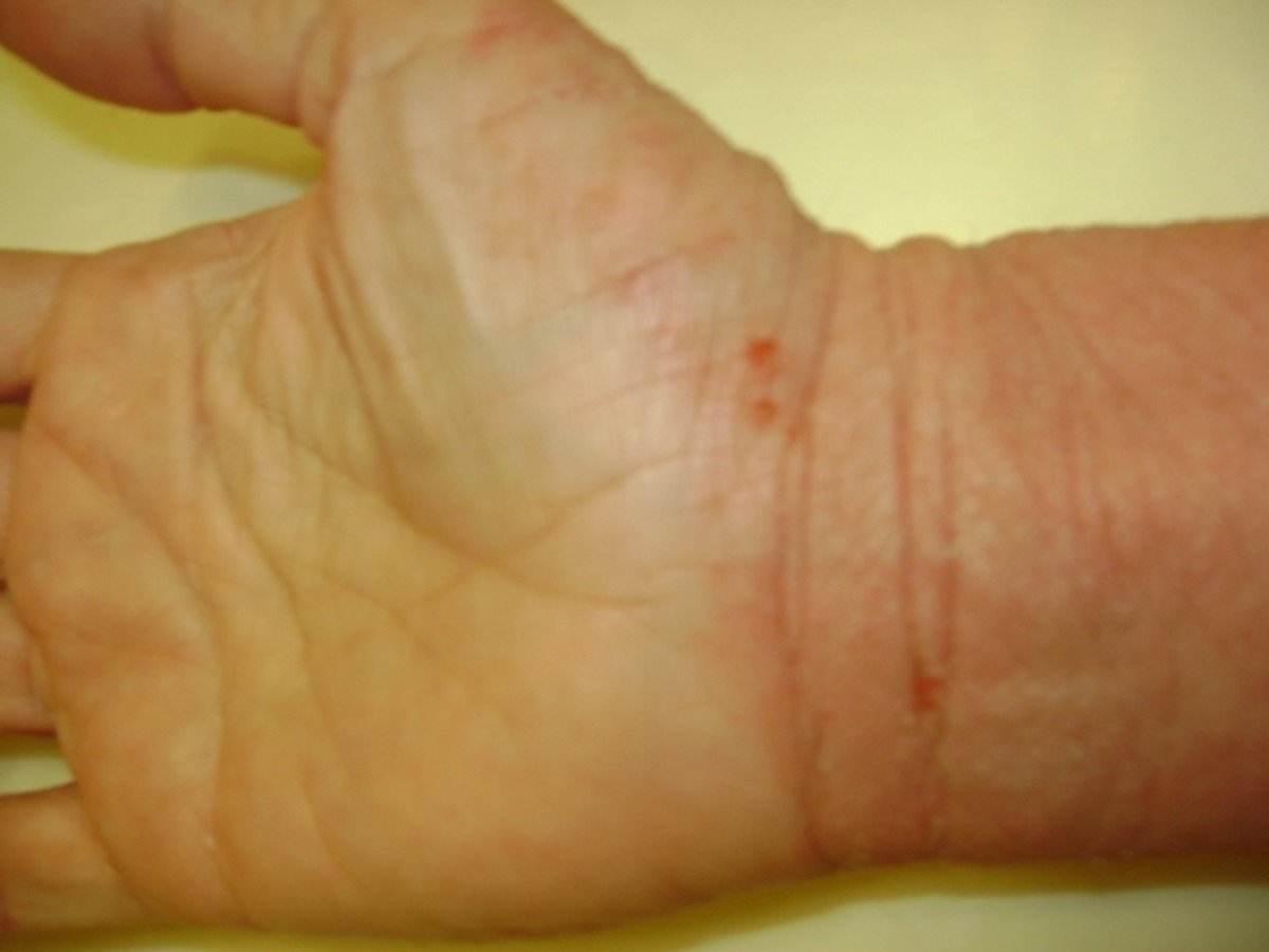 How do You Know if You Have True Eczema?
